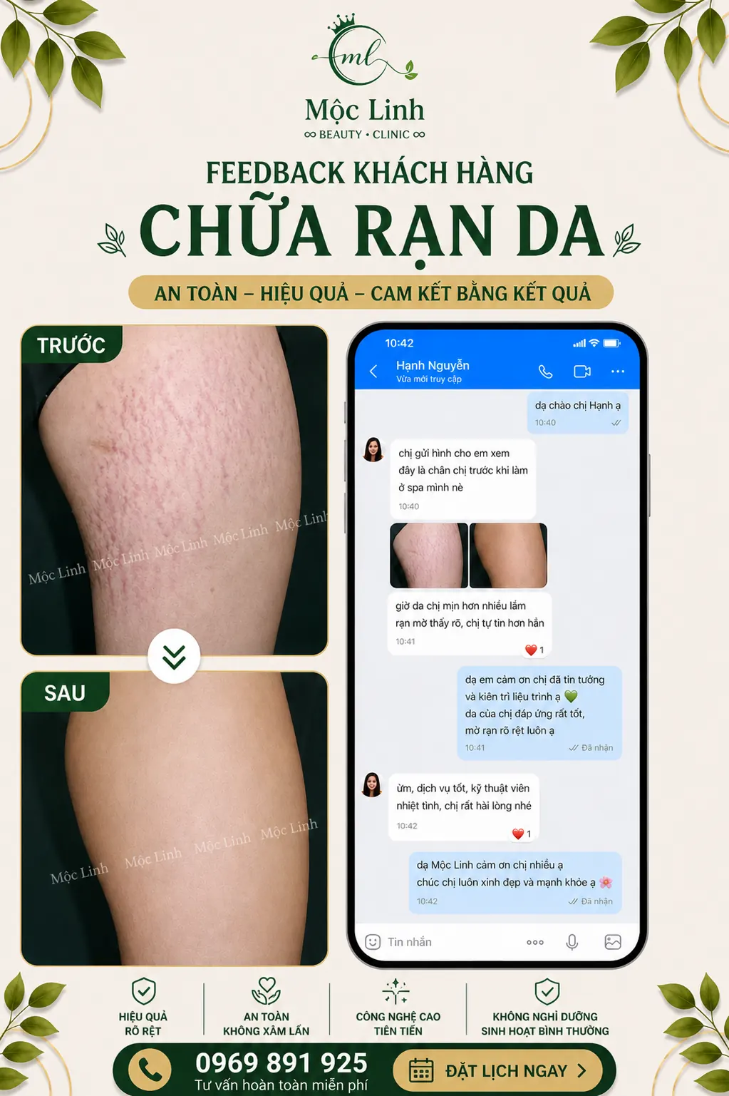 Chữa rạn da tại Thẩm Mỹ Mộc Linh Hải Phòng - hình 7