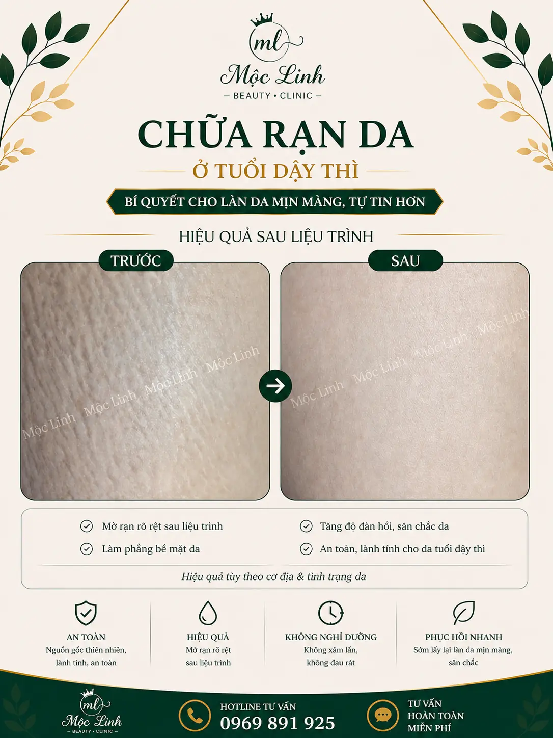 Chữa rạn da tại Thẩm Mỹ Mộc Linh Hải Phòng - hình 4