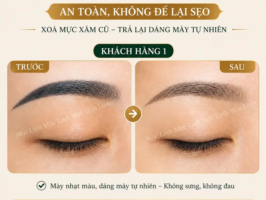 Xoá xăm mày - môi Hải Phòng tại Thẩm Mỹ Mộc Linh - hình 2