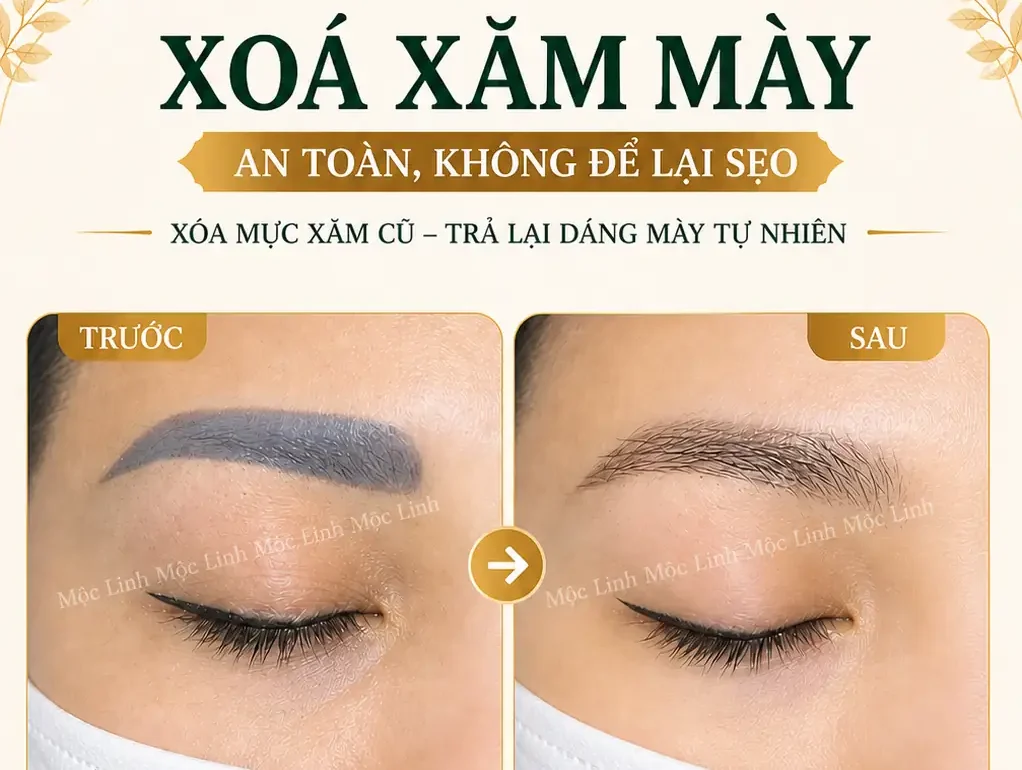 Xoá xăm mày - môi Hải Phòng tại Thẩm Mỹ Mộc Linh - hình 3
