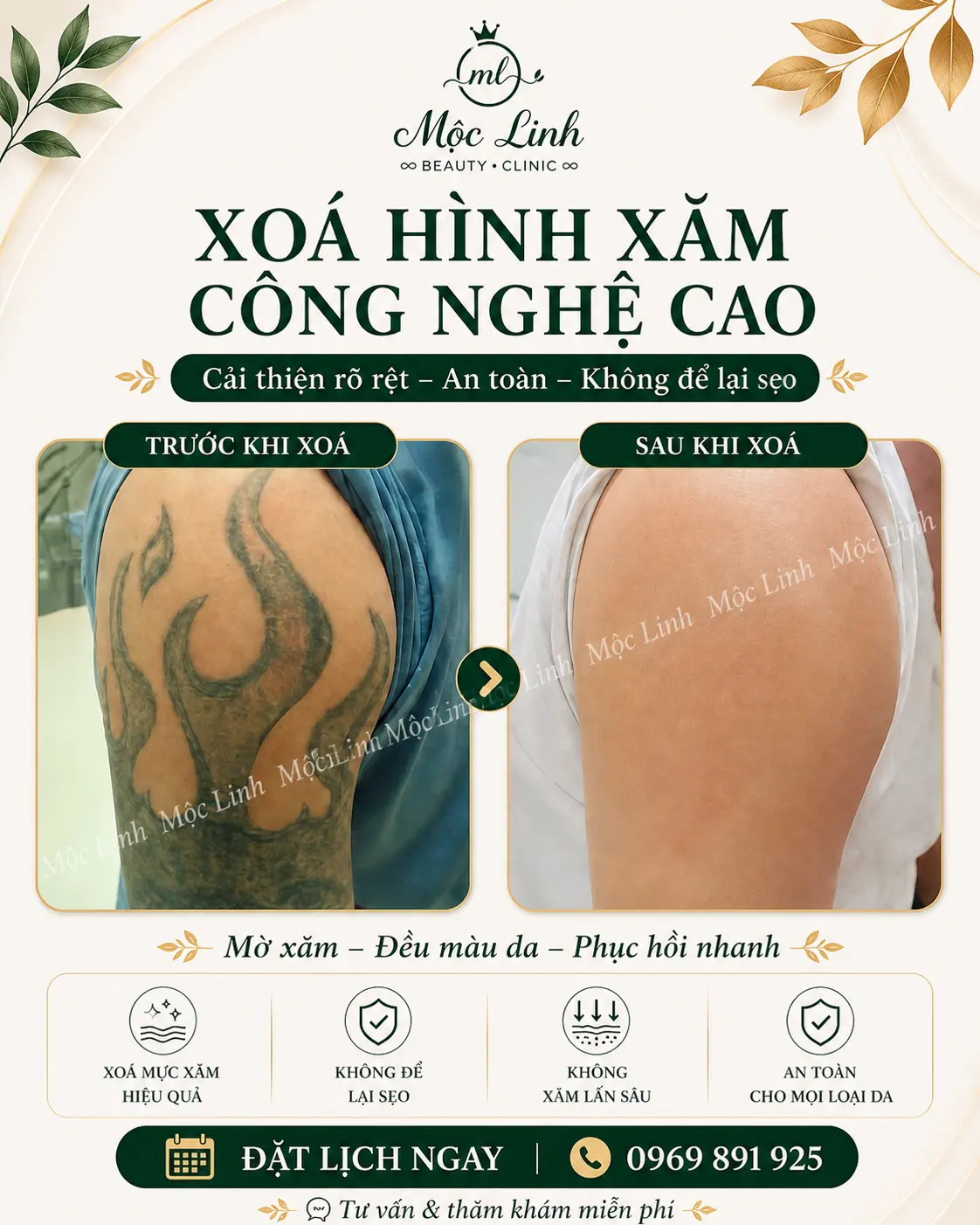 Xoá hình xăm Hải Phòng tại Thẩm Mỹ Mộc Linh - hình 5