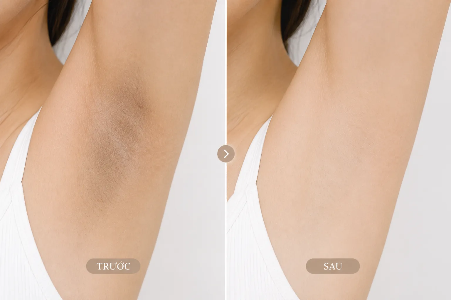 Sau trị thâm nách kiêng gì để không tái thâm tại Hải Phòng