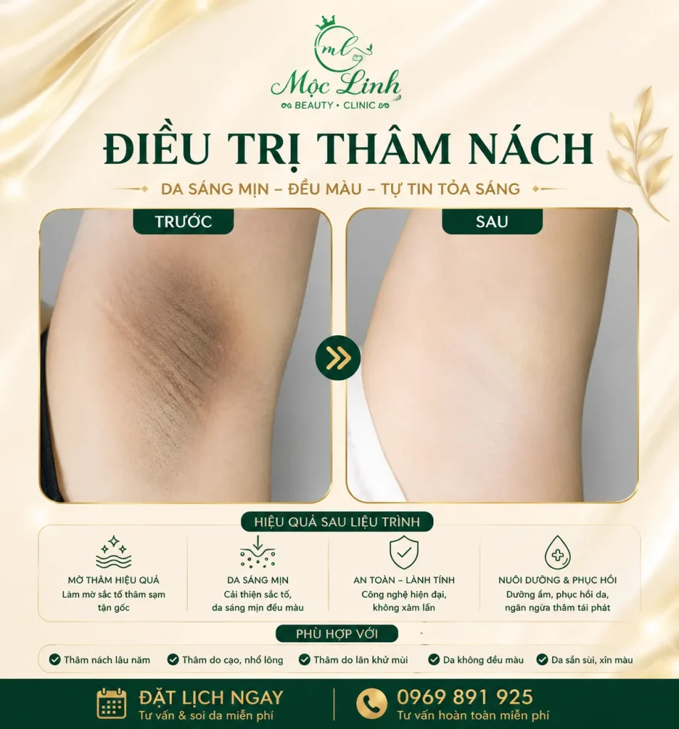 Trị thâm nách - bẹn Hải Phòng tại Thẩm Mỹ Mộc Linh - hình 13