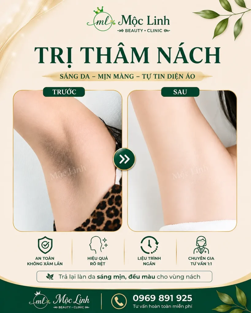 Trị thâm nách - bẹn Hải Phòng tại Thẩm Mỹ Mộc Linh - hình 7
