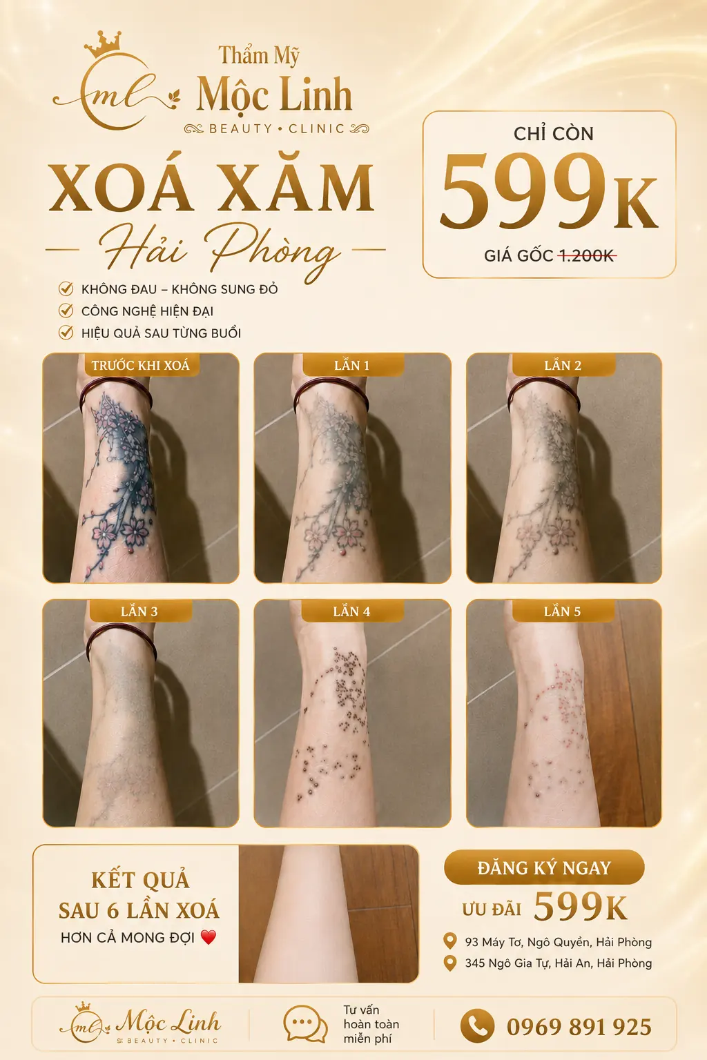 Xoá hình xăm Hải Phòng tại Thẩm Mỹ Mộc Linh - hình 6