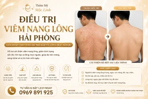 Điều Trị Viêm Nang Lông Hải Phòng – Giải Pháp Cho Vùng tại Thẩm Mỹ Mộc Linh - hình 7