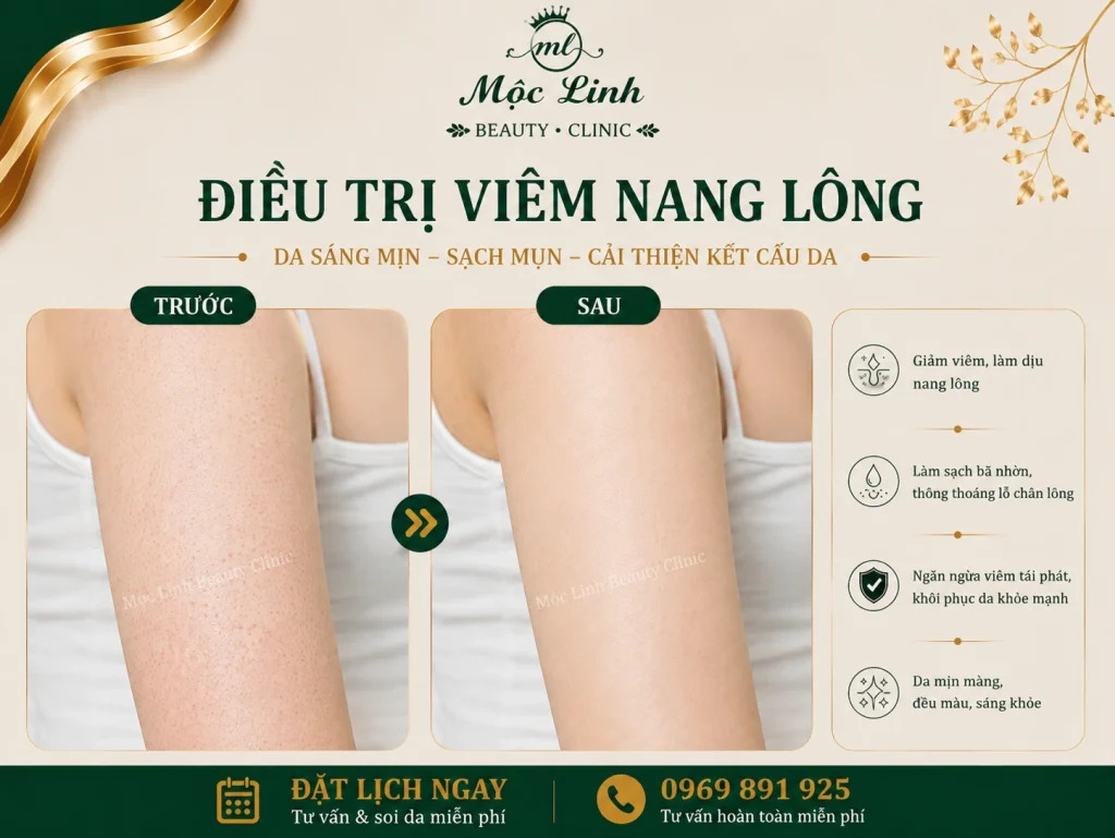 Điều Trị Viêm Nang Lông Hải Phòng – Giải Pháp Cho Vùng tại Thẩm Mỹ Mộc Linh - hình 6
