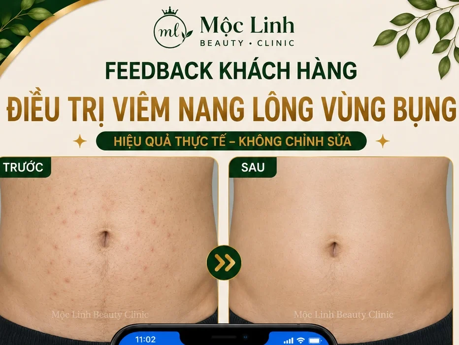 Điều Trị Viêm Nang Lông Hải Phòng – Giải Pháp Cho Vùng tại Thẩm Mỹ Mộc Linh - hình 1