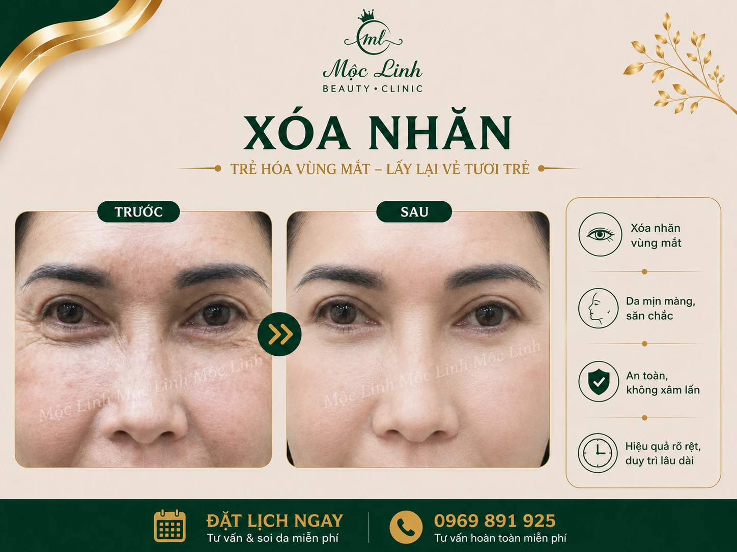 Xóa Nhăn Hải Phòng tại Thẩm Mỹ Mộc Linh - hình 4