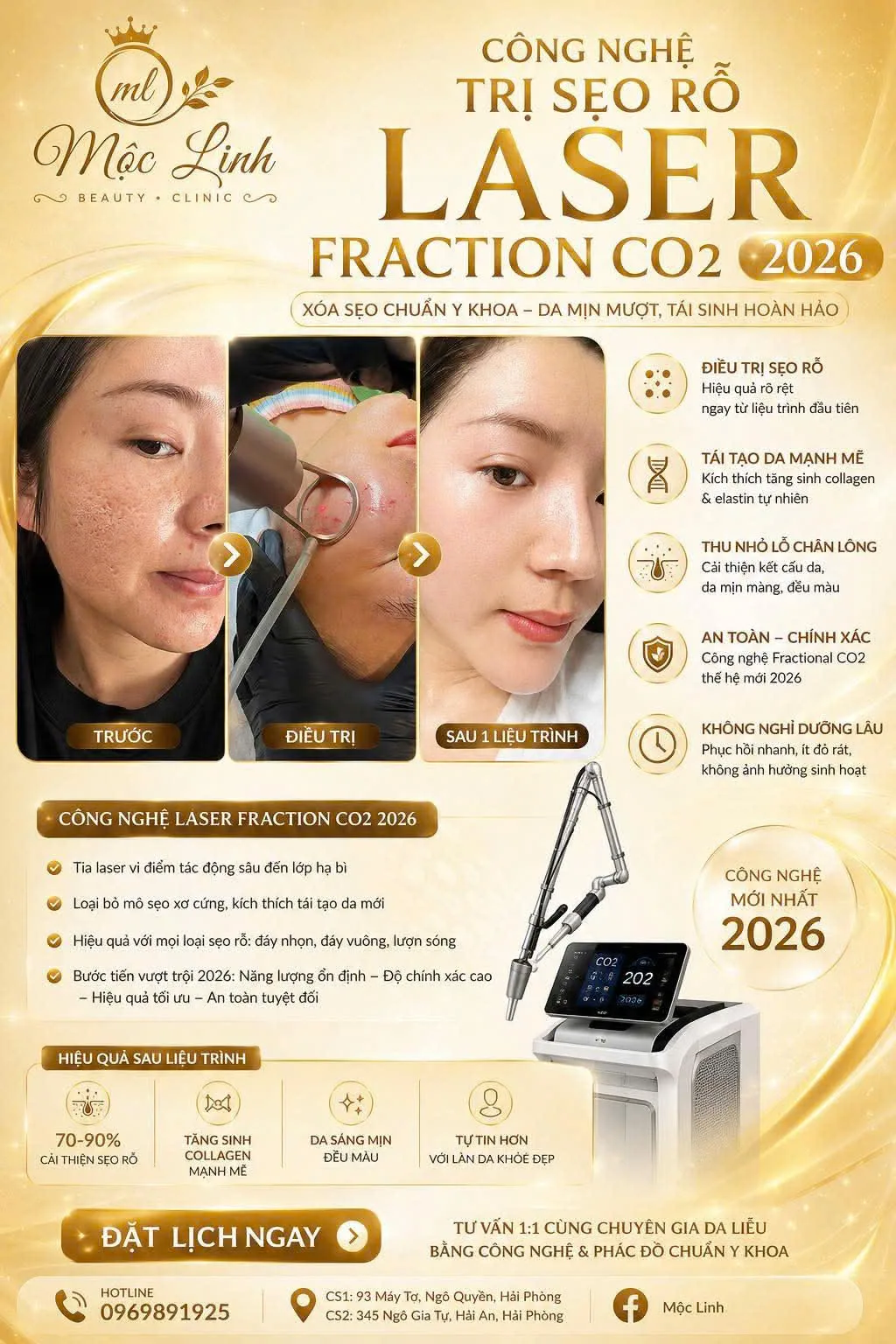 Trị sẹo rỗ bằng laser tại Thẩm Mỹ Mộc Linh Hải Phòng - hình 2