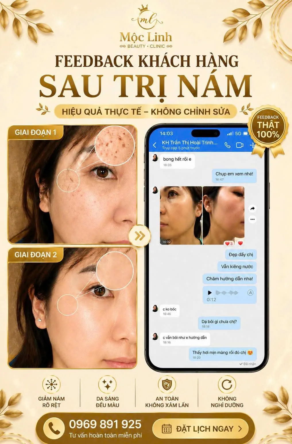 Làn da cải thiện sau lộ trình điều trị nám tại Hải Phòng
