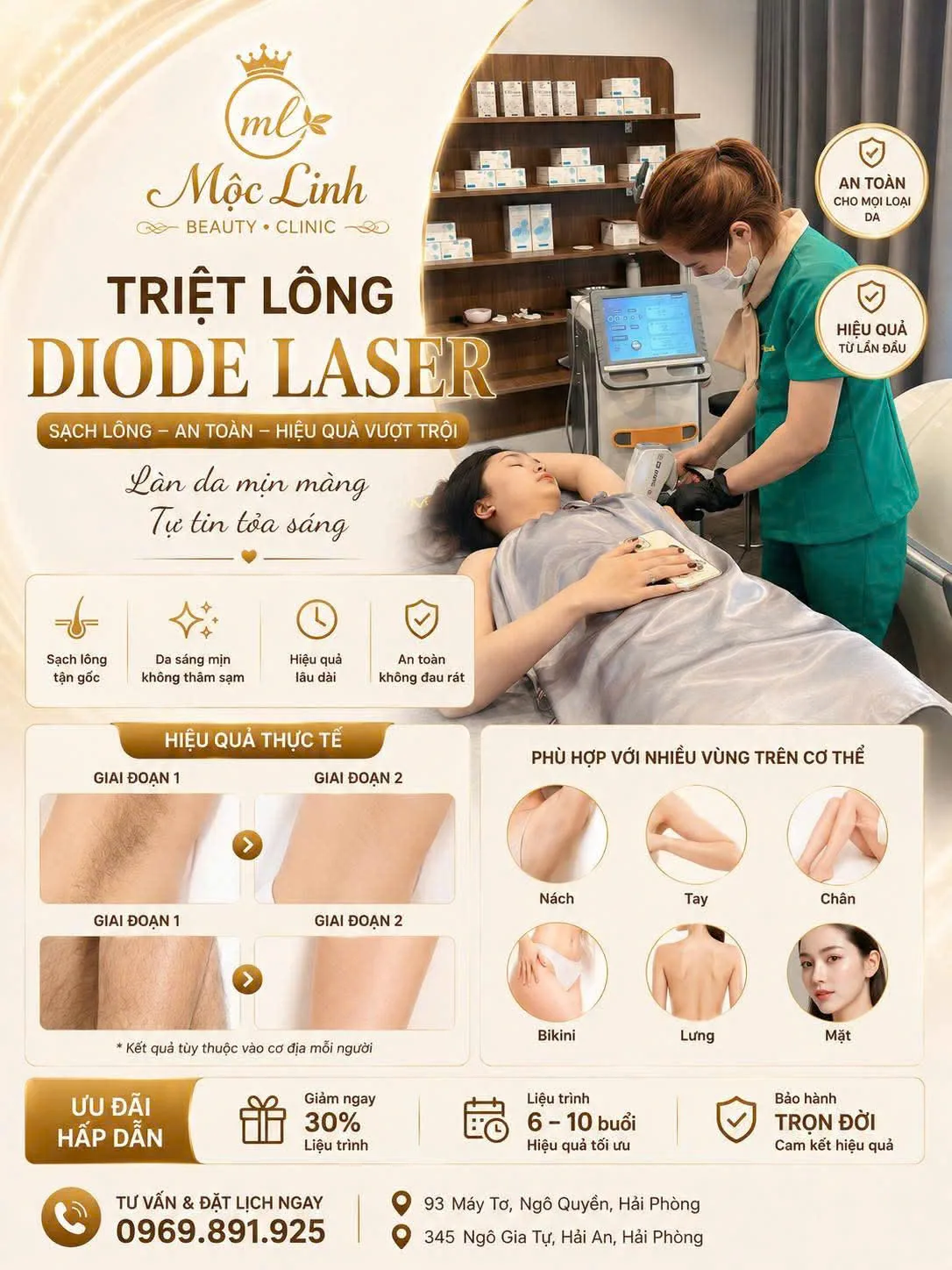 Máy triệt lông diode laser đầu làm lạnh tại Thẩm Mỹ Mộc Linh Hải Phòng