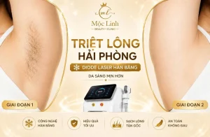 Triệt lông Hải Phòng - Triệt lông tại Thẩm mỹ viện Mộc Linh Hải Phòng