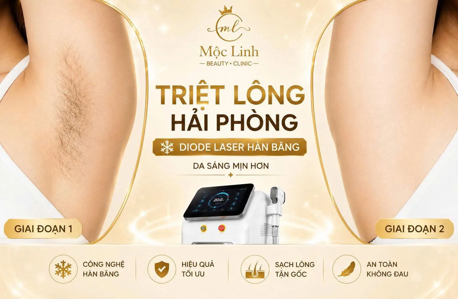 Triệt lông vùng bikini có an toàn không tại Hải Phòng